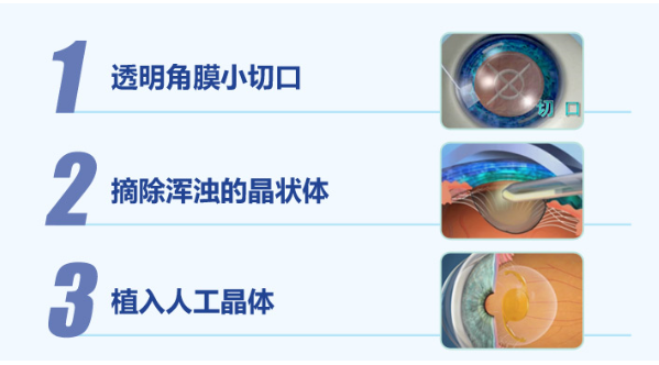 白內障手術(shù)